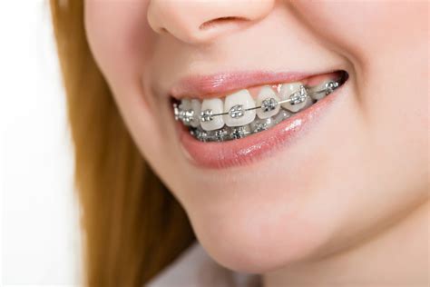 de que están hechos los brackets de metal|Brackets metálicos o frenillos metálicos .